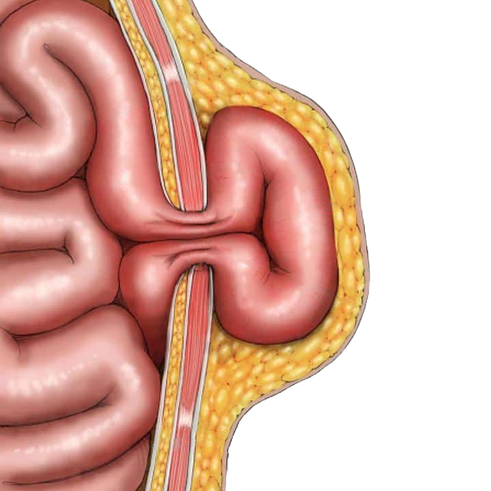 Hernia Especialistas de El Salvador
