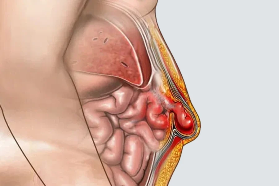 Riesgos de no tratar una hernia gigante - Hernia Especialistas de El Salvador