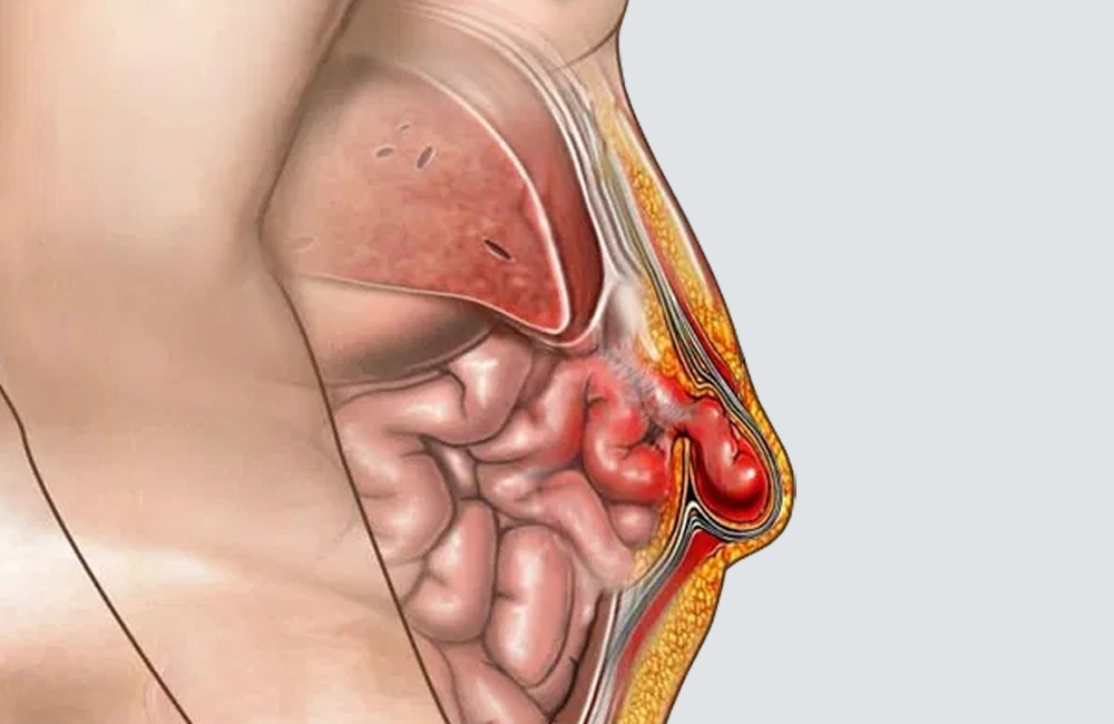 Riesgos de no tratar una hernia gigante