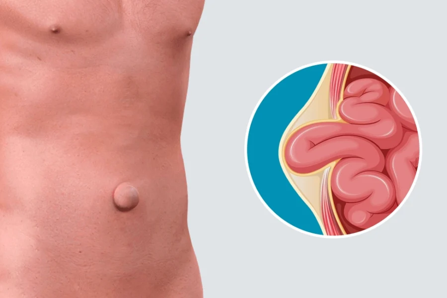 ¿Por qué se forman las hernias? Causas y factores de riesgo - Hernia Especialistas de El Salvador