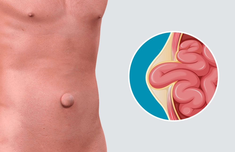 ¿Por qué se forman las hernias? Causas y factores de riesgo