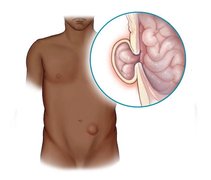 Hernia de Spiegel - Hernia Especialistas El Salvador