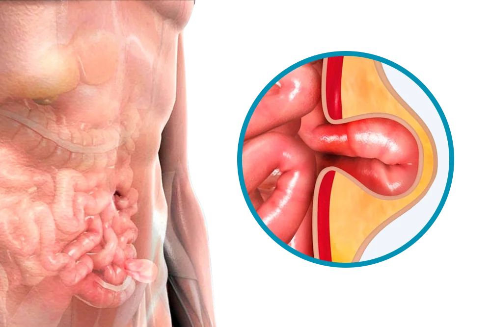 Hernia de Spiegel - Hernia Especialistas El Salvador