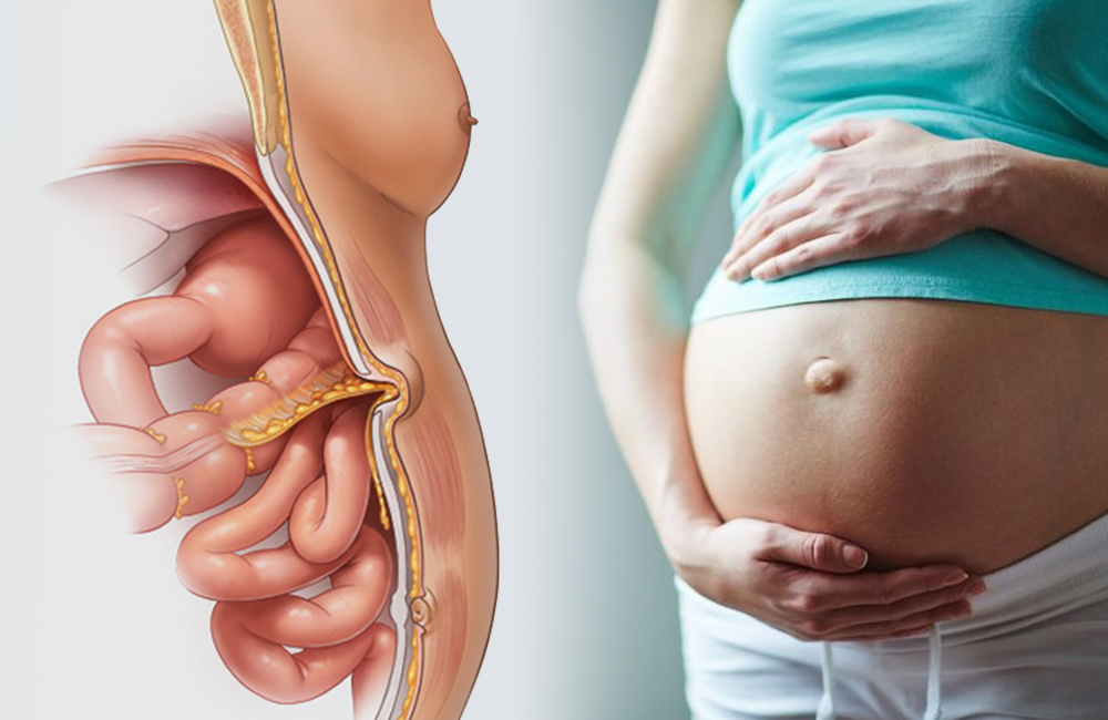 ¿Por qué pueden aparecer hernias durante el embarazo?