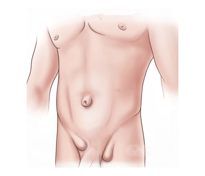 Hernia Umbilical - Hernia Especialistas El Salvador